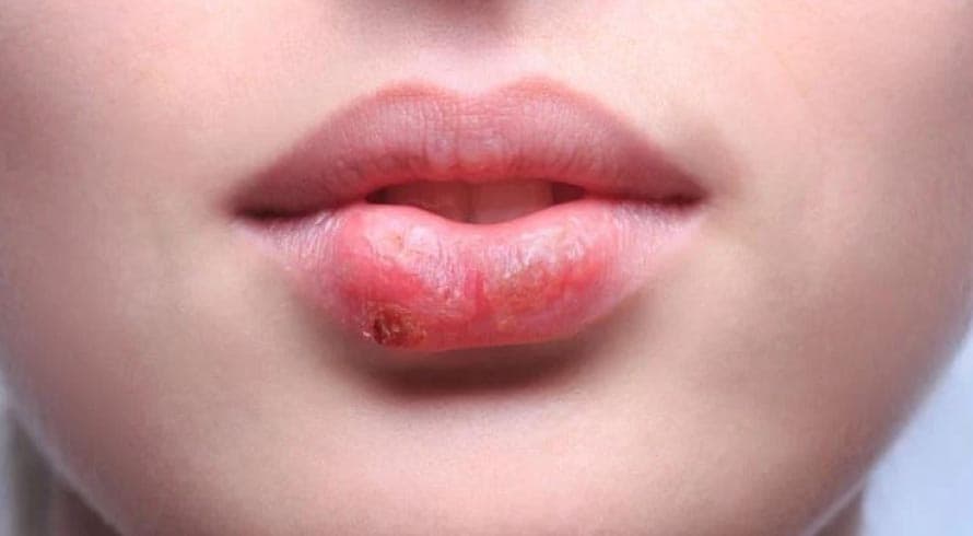 Herpes Labial - Saiba Como Prevenir e Cuidar