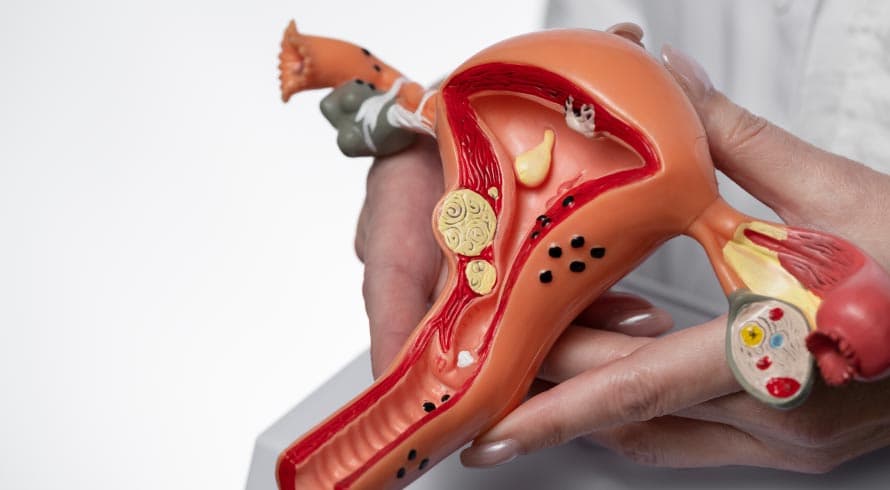 SUPERANDO A ENDOMETRIOSE: ABORDAGENS EFETIVAS PARA ALIVIAR OS SINTOMAS